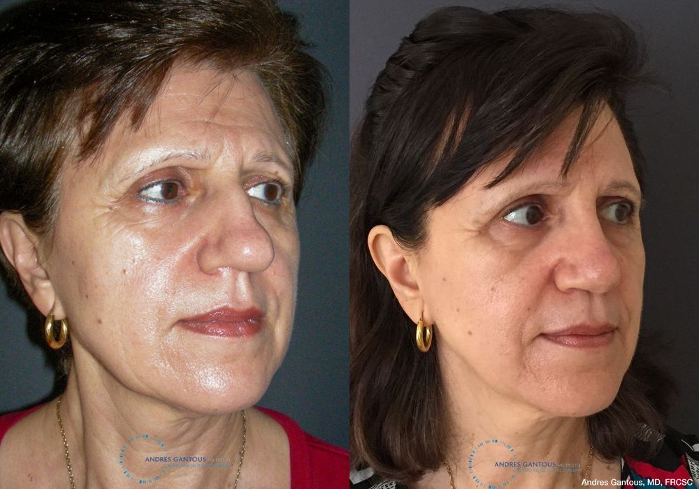 Rhinoplasty - Thumbnail 3