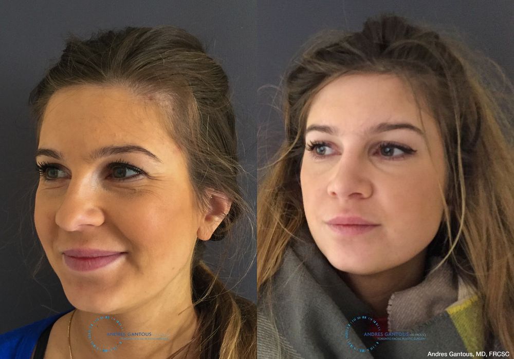 Rhinoplasty - Thumbnail 4