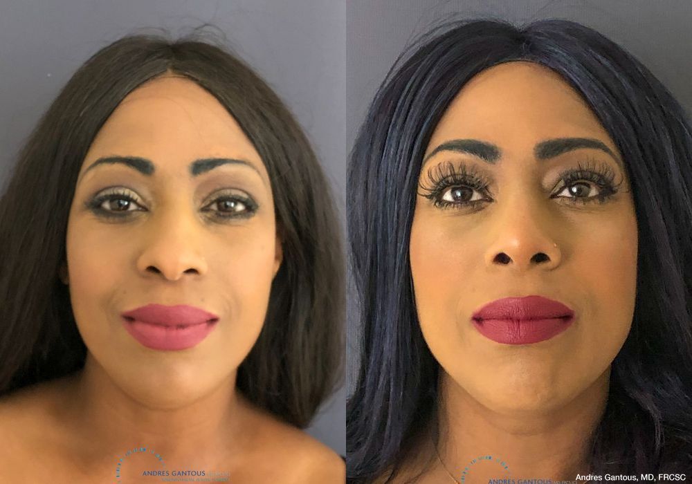 Rhinoplasty - Case 6722