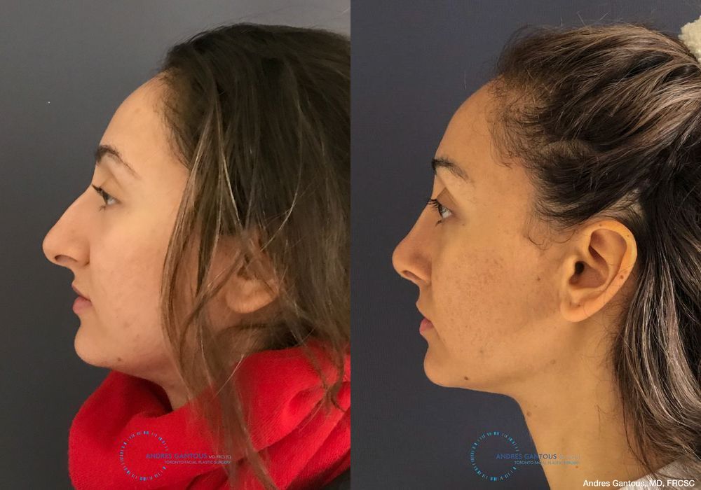 Rhinoplasty - Thumbnail 6