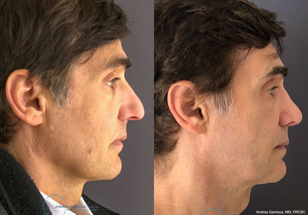 Rhinoplasty - Thumbnail 5