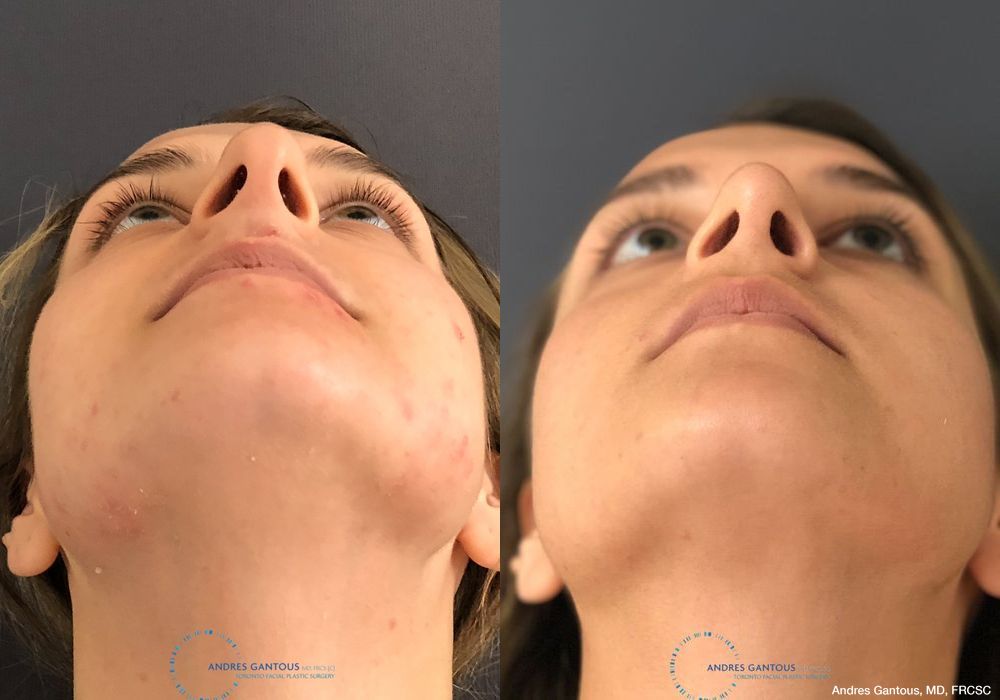 Rhinoplasty - Thumbnail 2