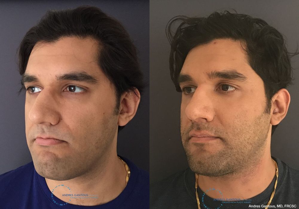 Before and after Rhinoplasty case 11649 - Angle 4