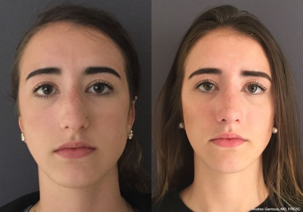 Rhinoplasty - Case 6753