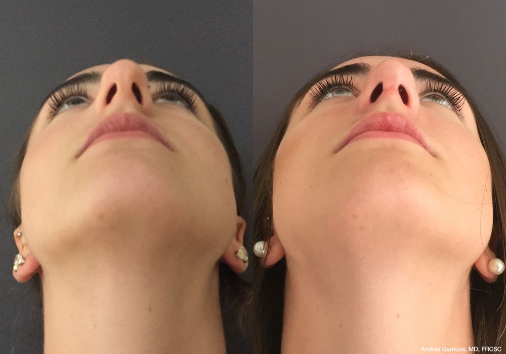 Rhinoplasty - Thumbnail 2