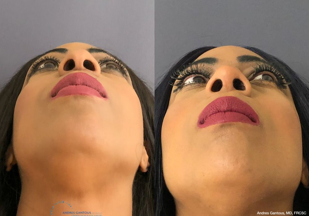 Rhinoplasty - Thumbnail 2