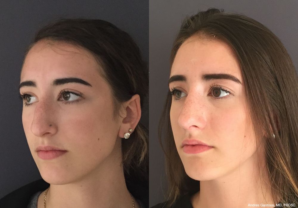 Rhinoplasty - Thumbnail 4