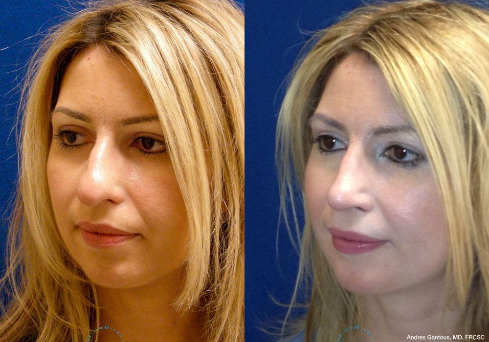 Rhinoplasty - Thumbnail 2