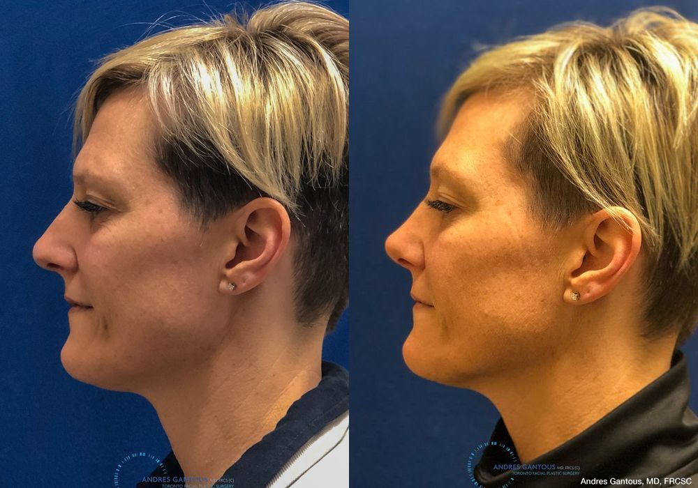 Rhinoplasty - Thumbnail 6