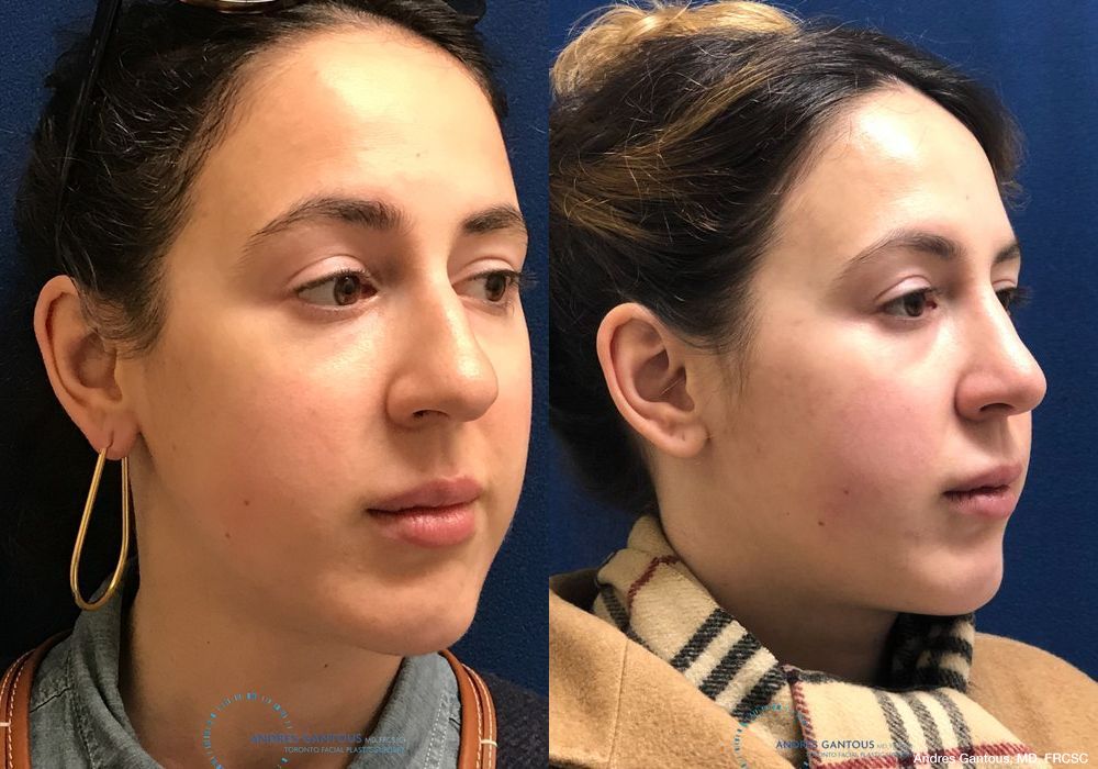 Rhinoplasty - Thumbnail 3