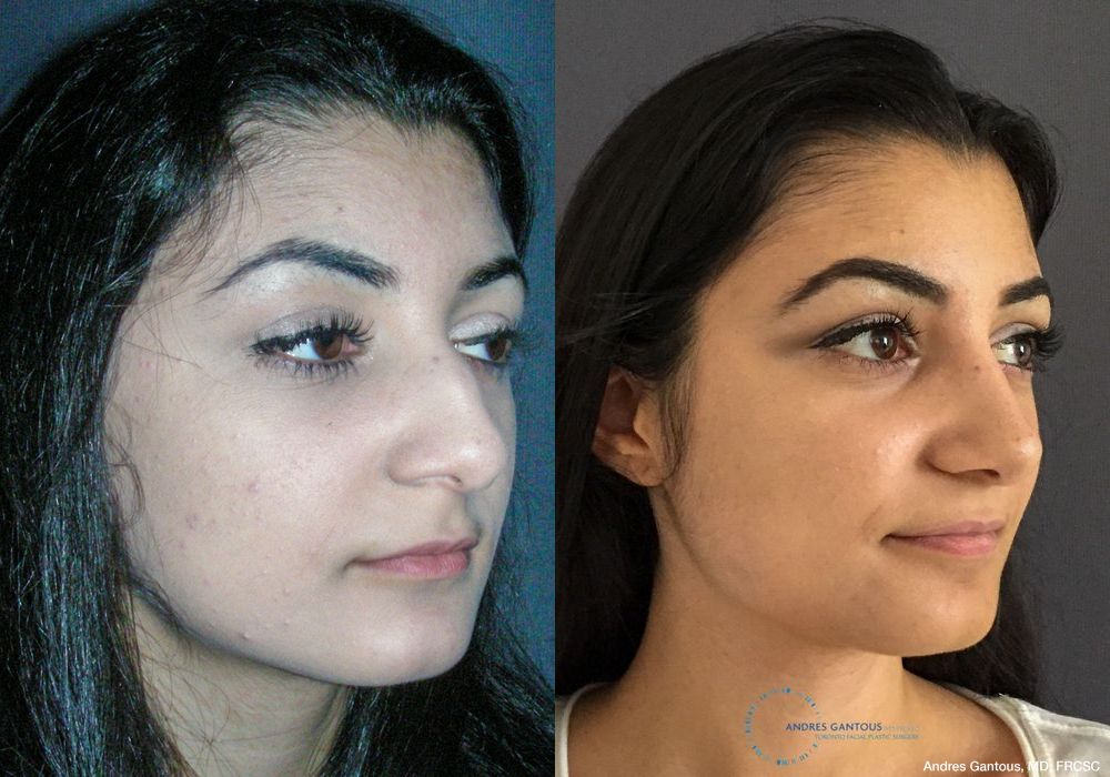 Rhinoplasty - Thumbnail 3