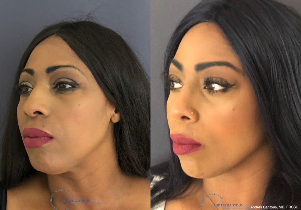 Rhinoplasty - Thumbnail 3