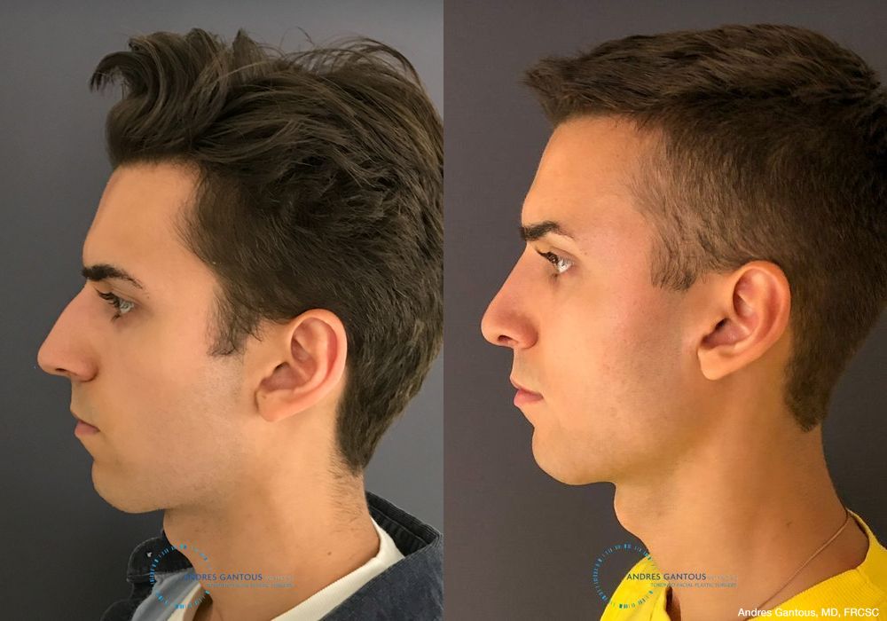 Rhinoplasty - Thumbnail 5