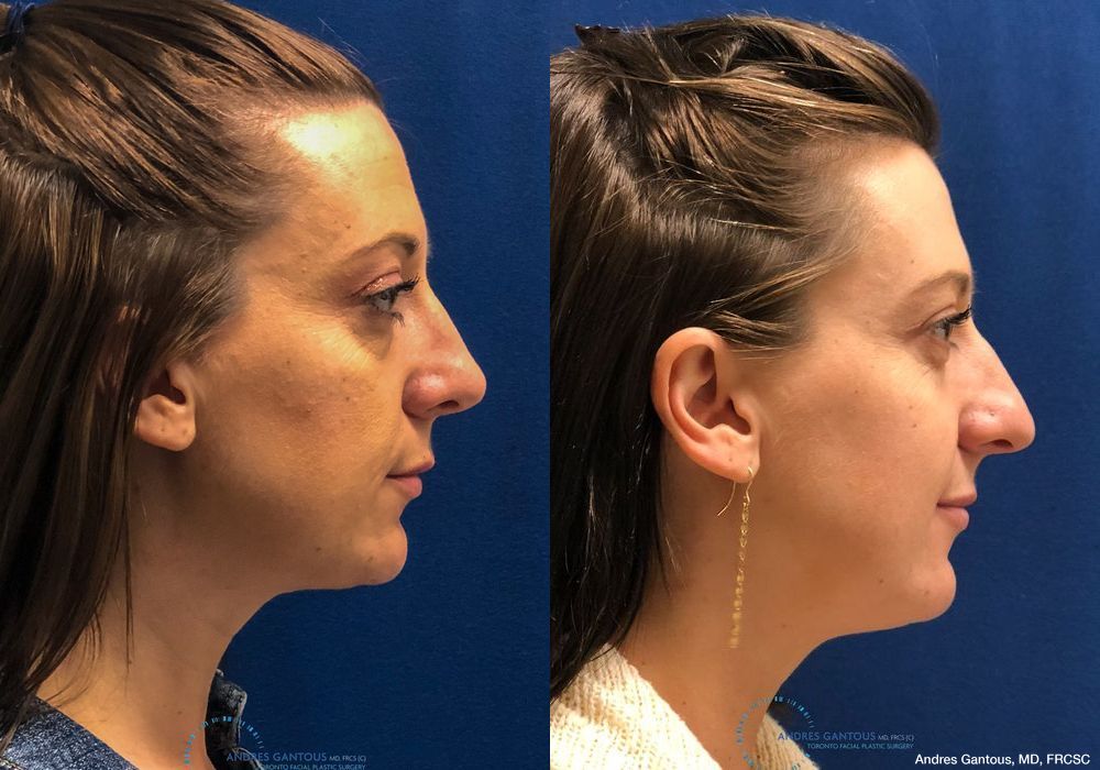 Rhinoplasty - Thumbnail 5