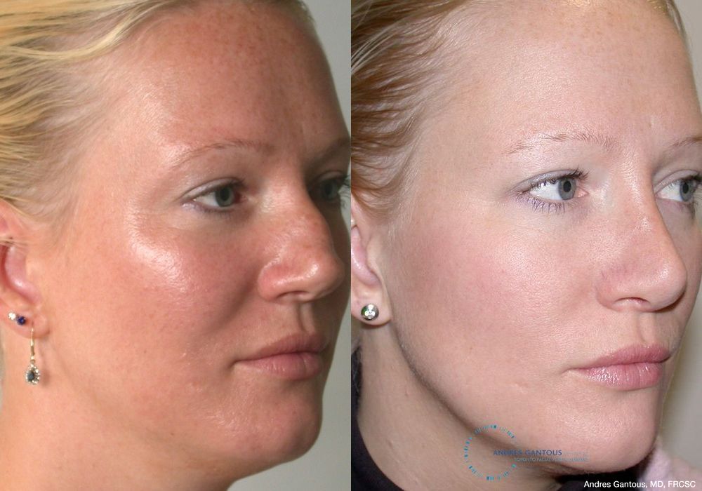 Rhinoplasty - Thumbnail 3