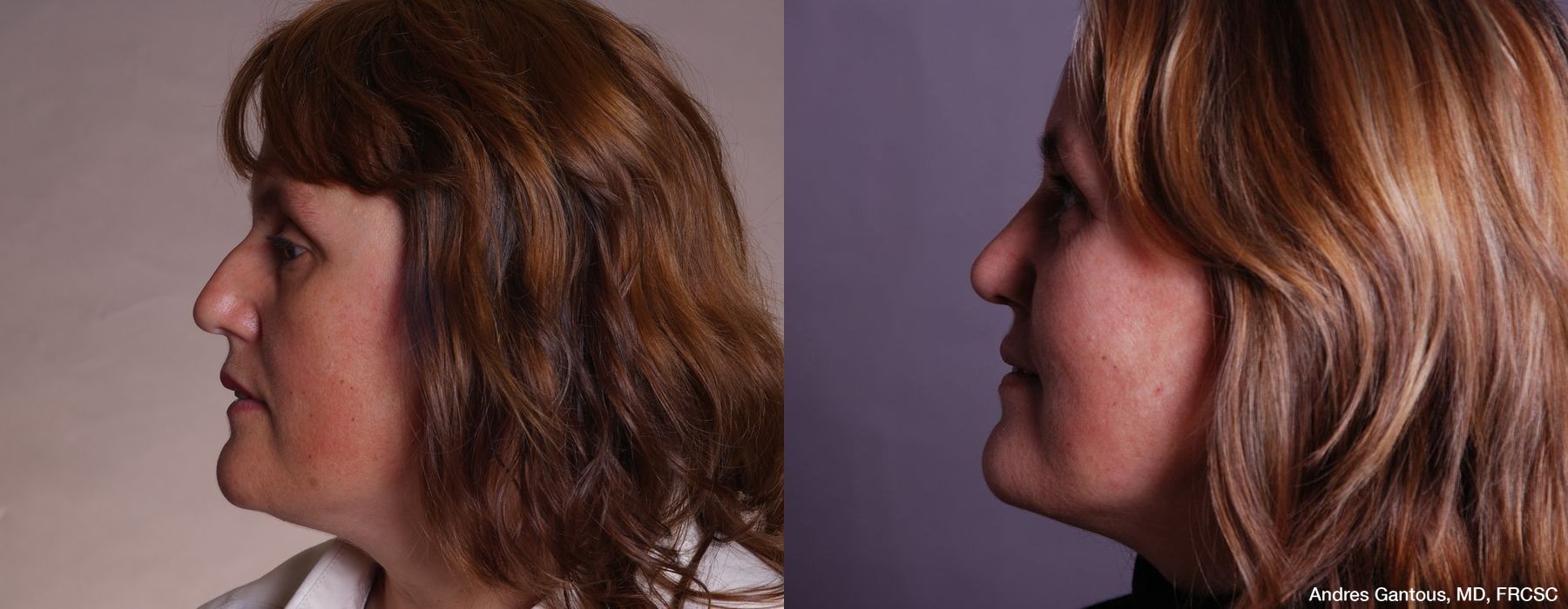 Rhinoplasty - Thumbnail 5