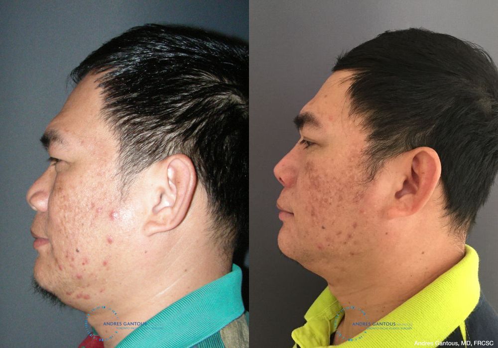 Rhinoplasty - Thumbnail 6