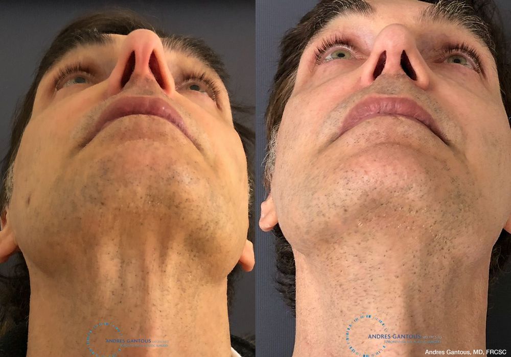 Rhinoplasty - Thumbnail 2