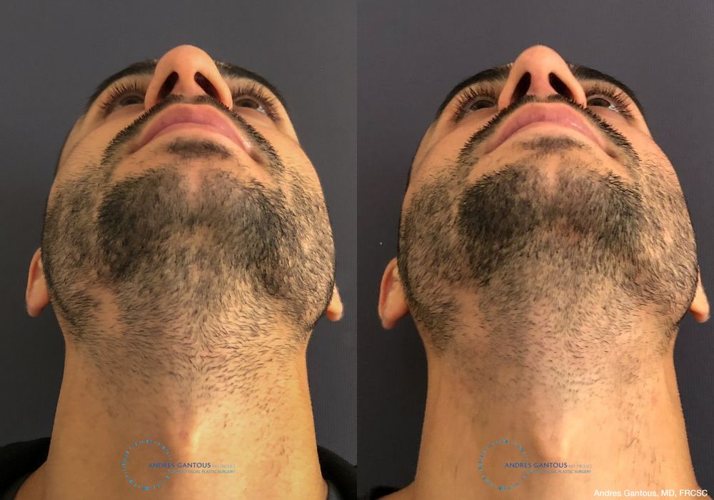 Rhinoplasty - Thumbnail 2