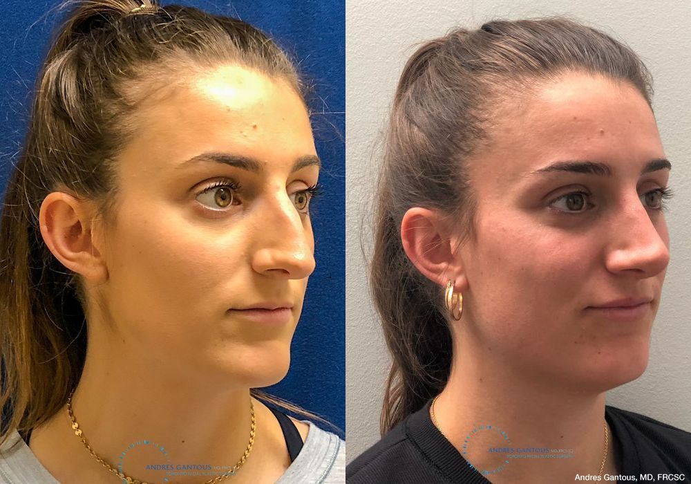 Rhinoplasty - Thumbnail 3