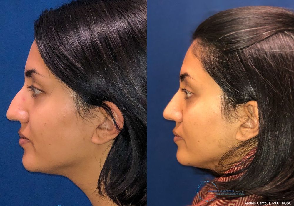 Rhinoplasty - Thumbnail 6