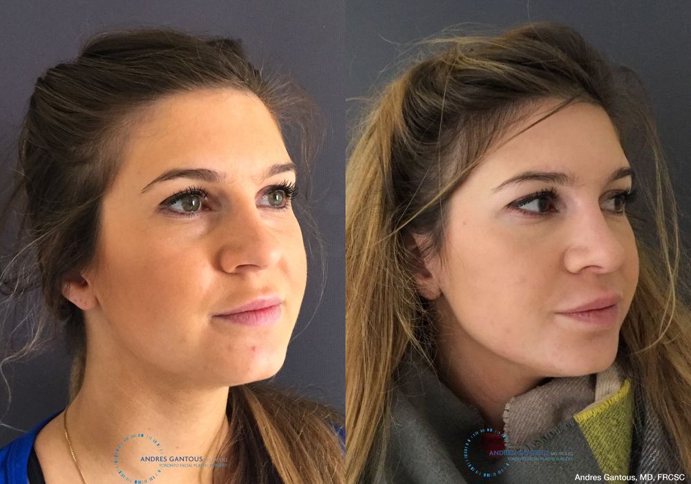 Rhinoplasty - Thumbnail 3