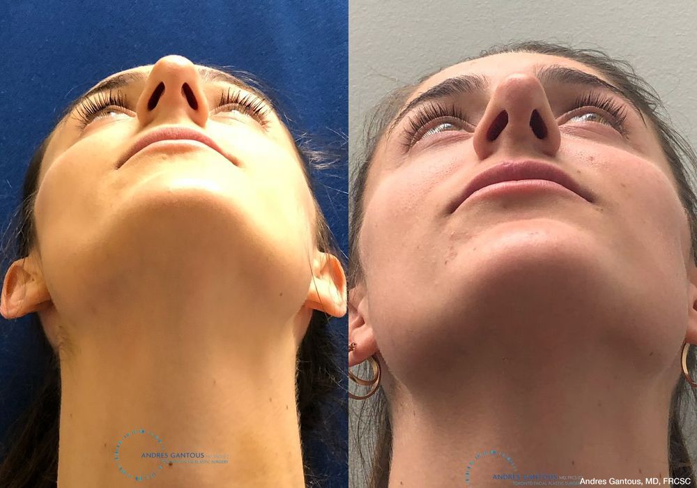 Rhinoplasty - Thumbnail 2