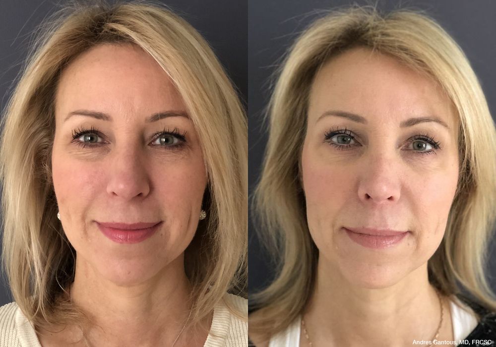 Rhinoplasty - Case 7162