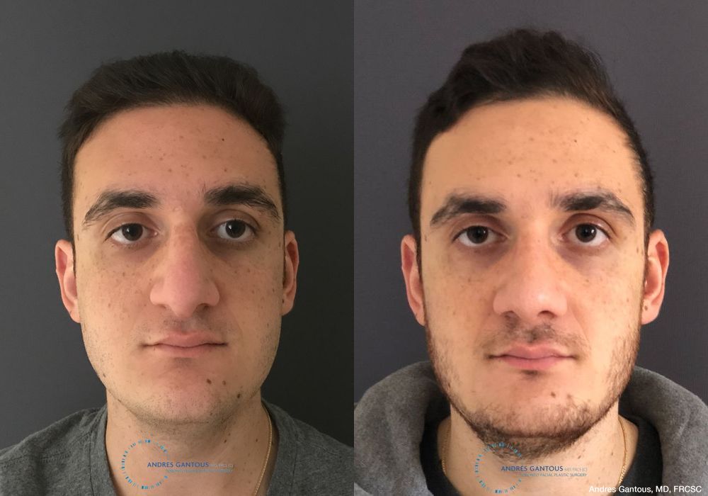 Rhinoplasty - Case 6737