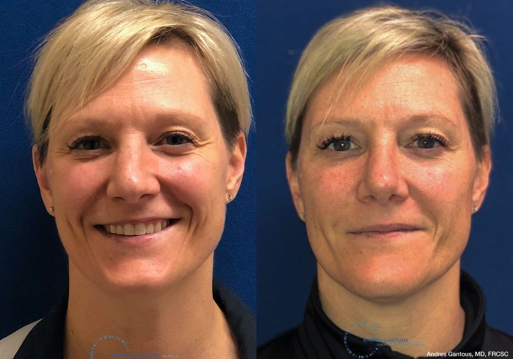 Rhinoplasty - Case 6724