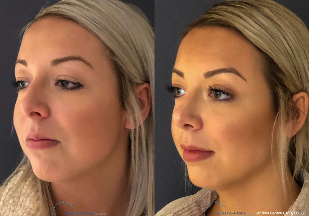 Rhinoplasty - Thumbnail 3