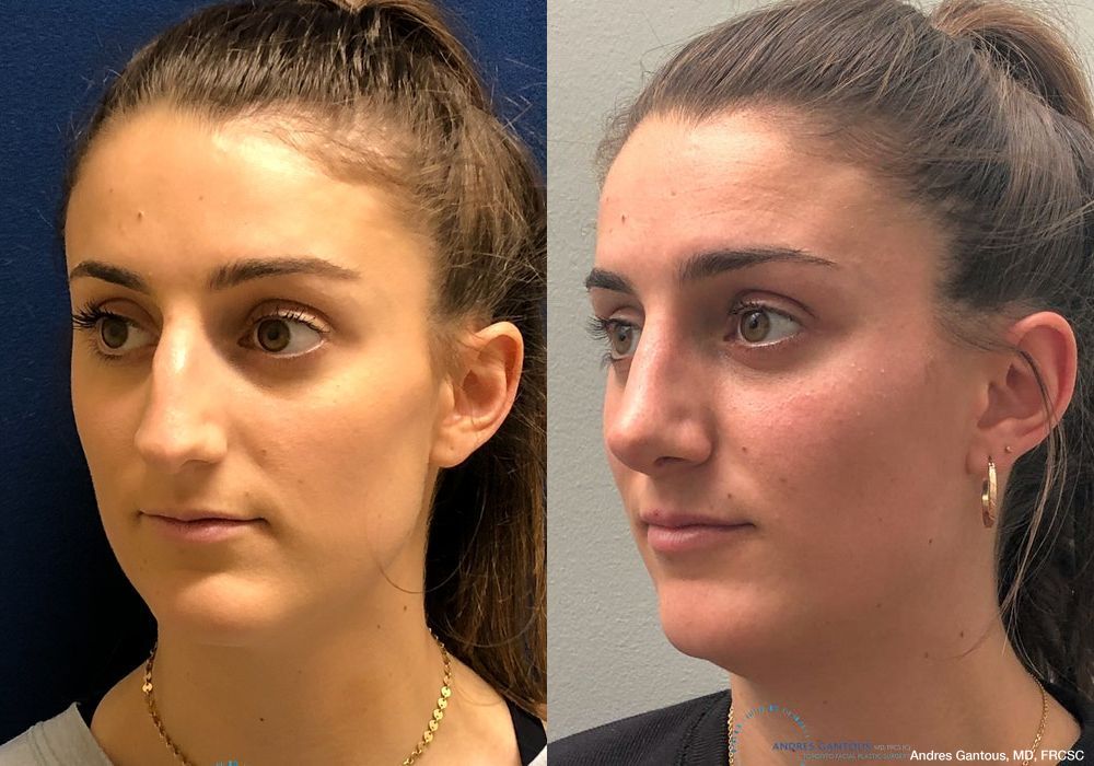 Rhinoplasty - Thumbnail 4