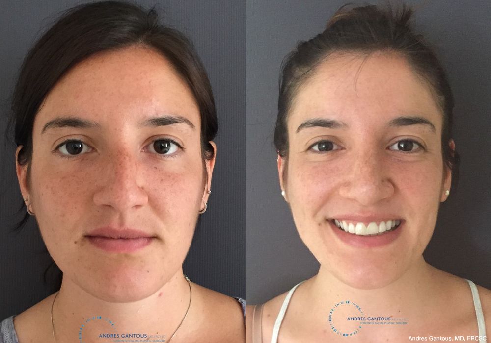 Rhinoplasty - Case 6739