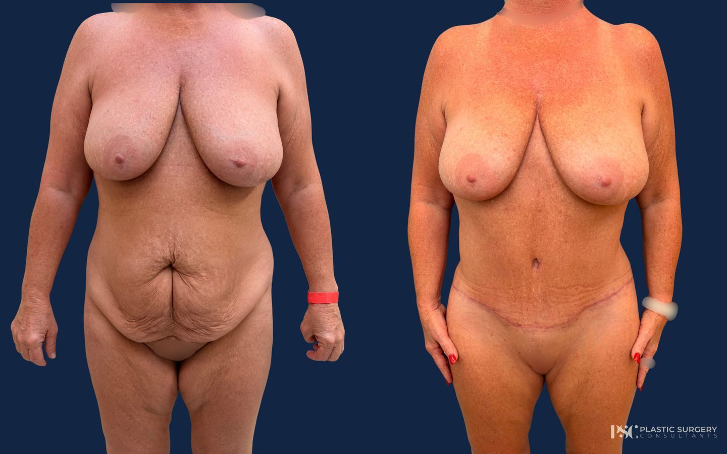 Before and after Anterior Torsoplasty case 49381