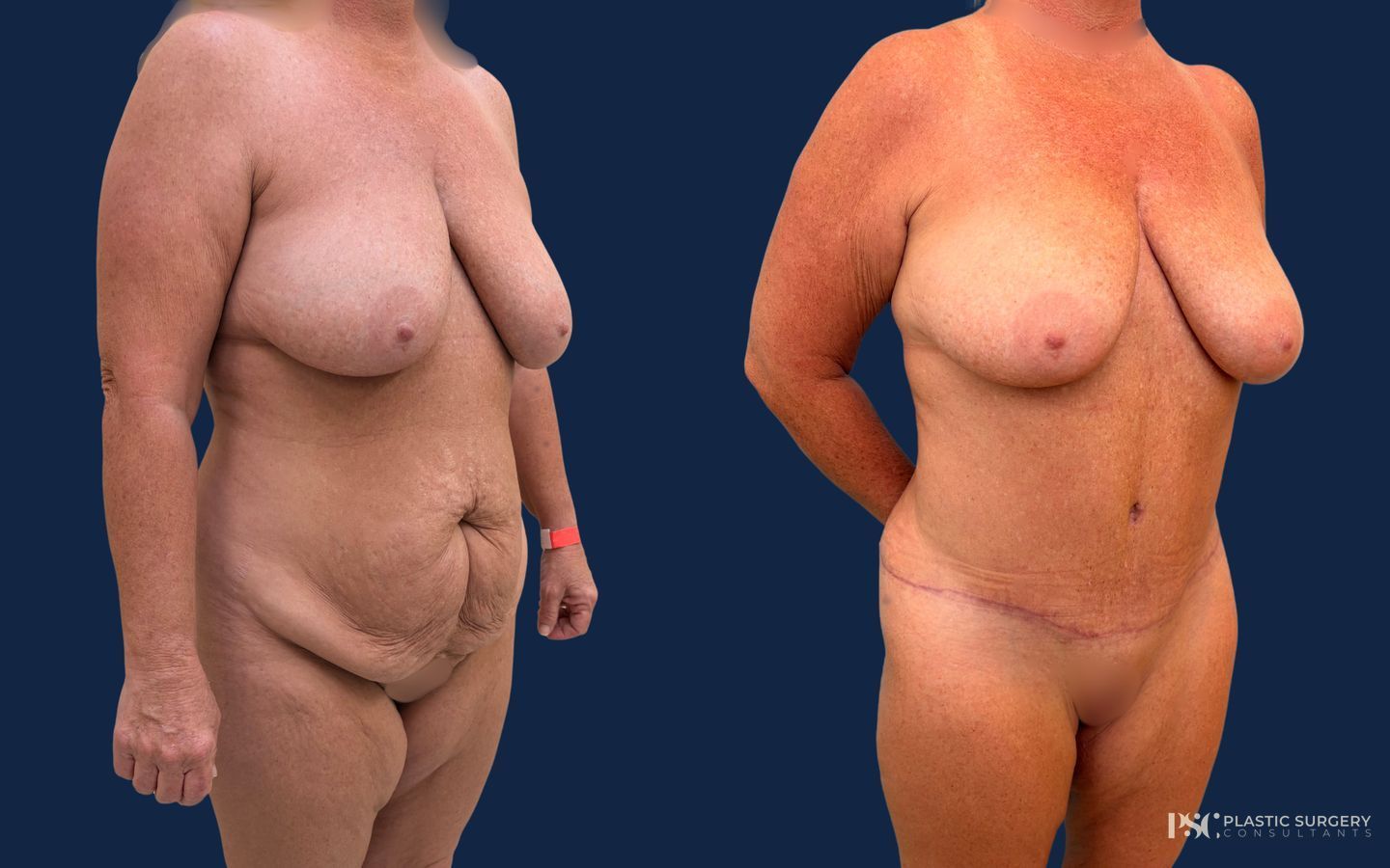 Before and after Anterior Torsoplasty case 49381 - Angle 2