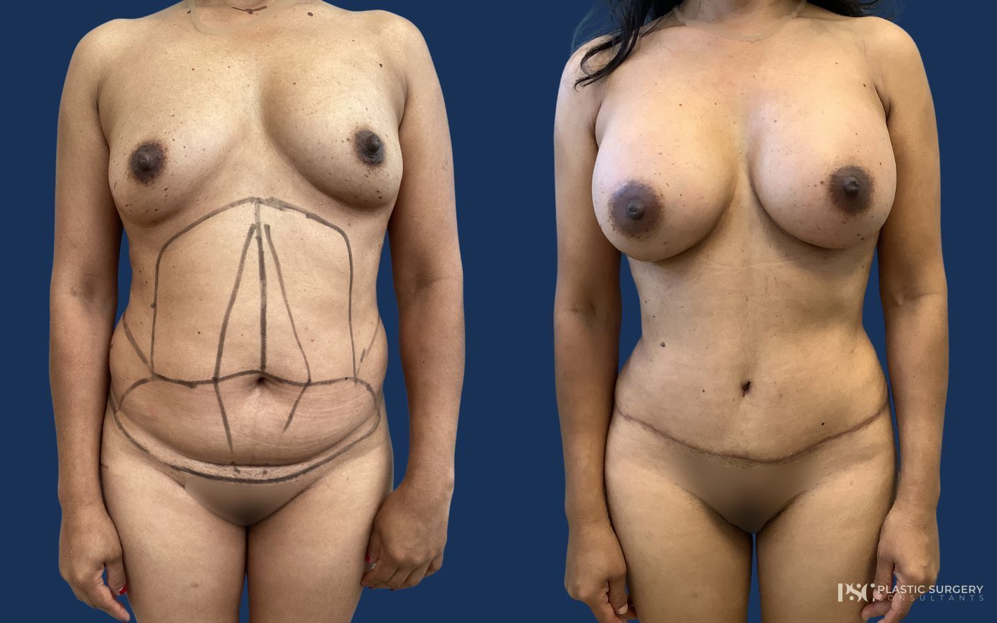Before and after Breast Augmentation case 33040