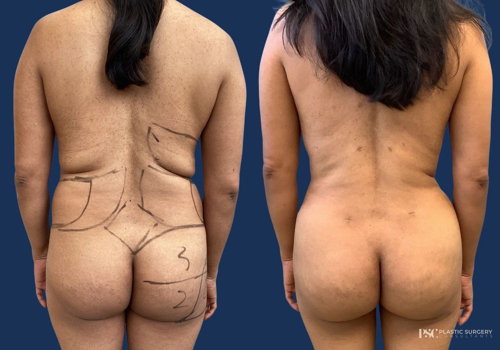 Before and after Dr. Richard J. Wassermann case 33040 - Angle 2