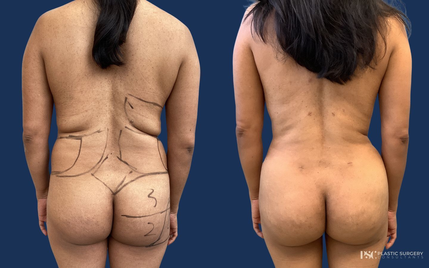 Before and after Free Fat Grafting case 33040 - Angle 2