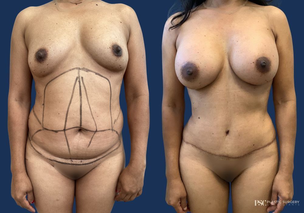 Before and after Dr. Richard J. Wassermann case 33040