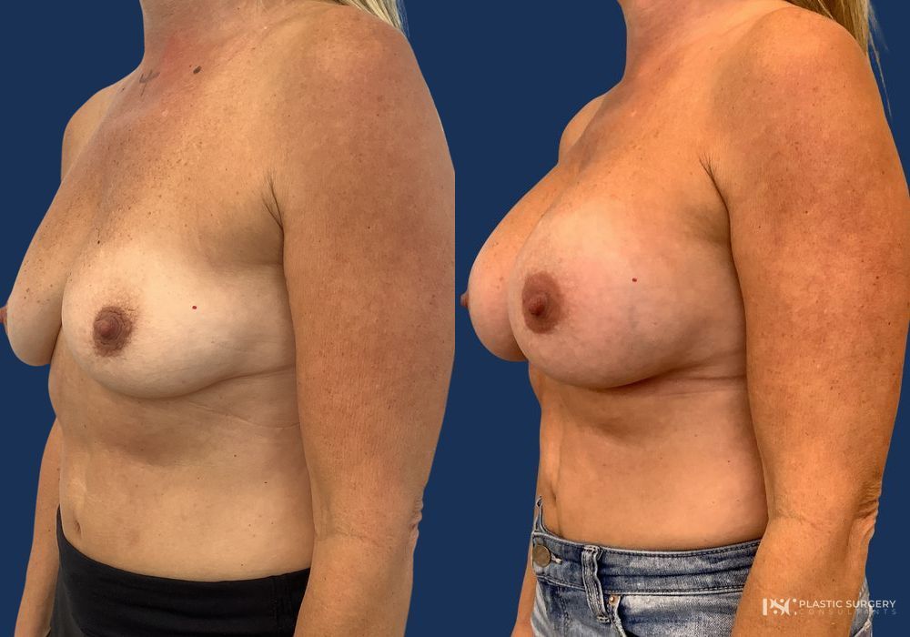 Before and after Dr. Richard J. Wassermann case 23868 - Angle 2