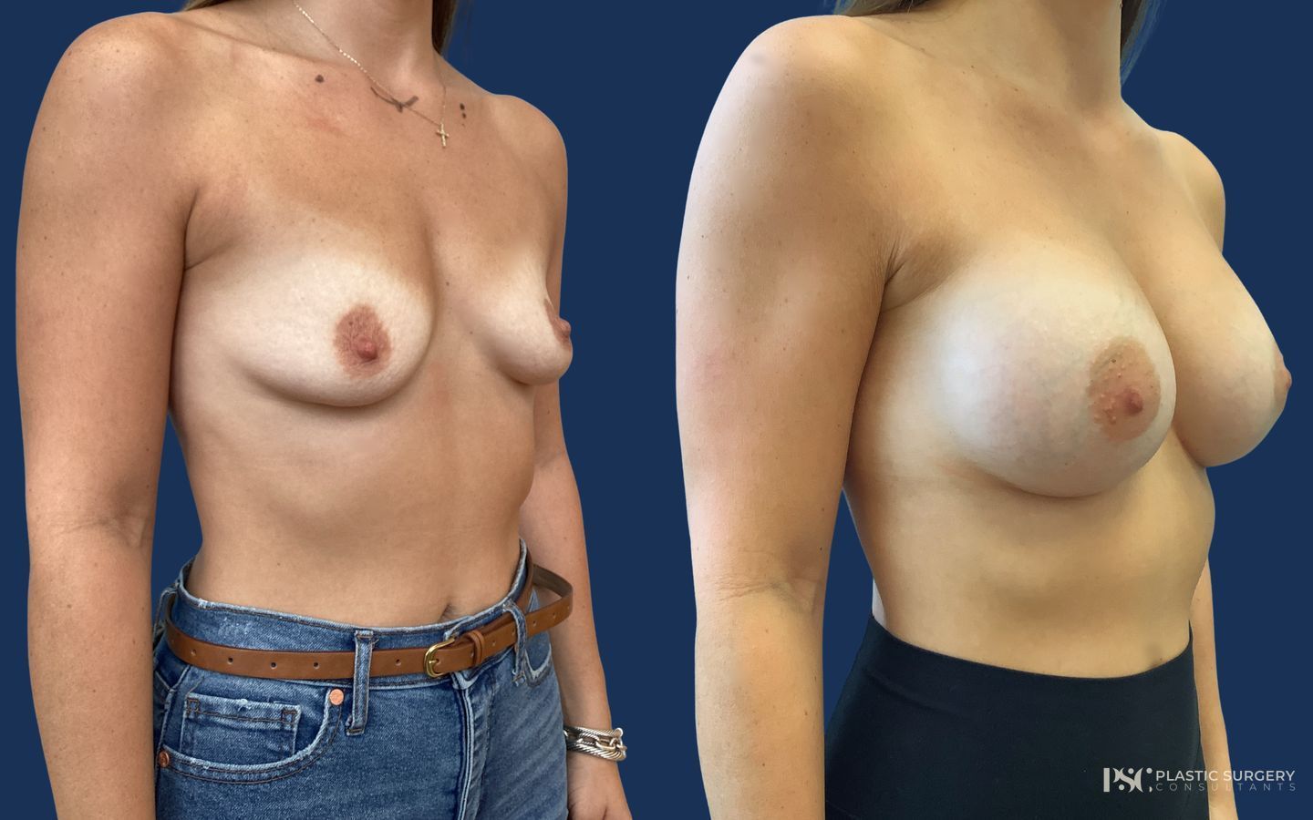 Before and after Breast Augmentation case 23867 - Angle 2