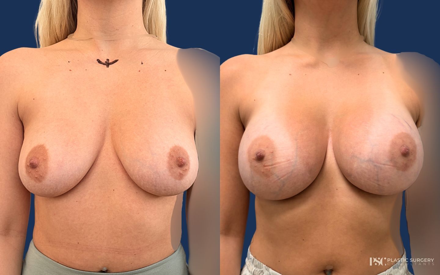 Before and after Breast Augmentation case 46025