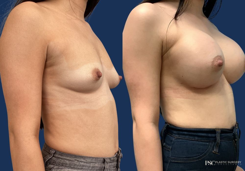 Before and after Dr. Richard J. Wassermann case 23871 - Angle 2