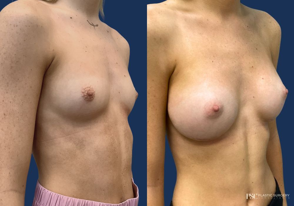 Before and after Dr. Richard J. Wassermann case 23870 - Angle 2