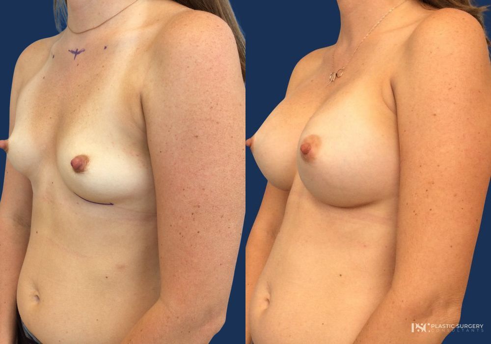 Before and after Dr. Richard J. Wassermann case 23873 - Angle 2