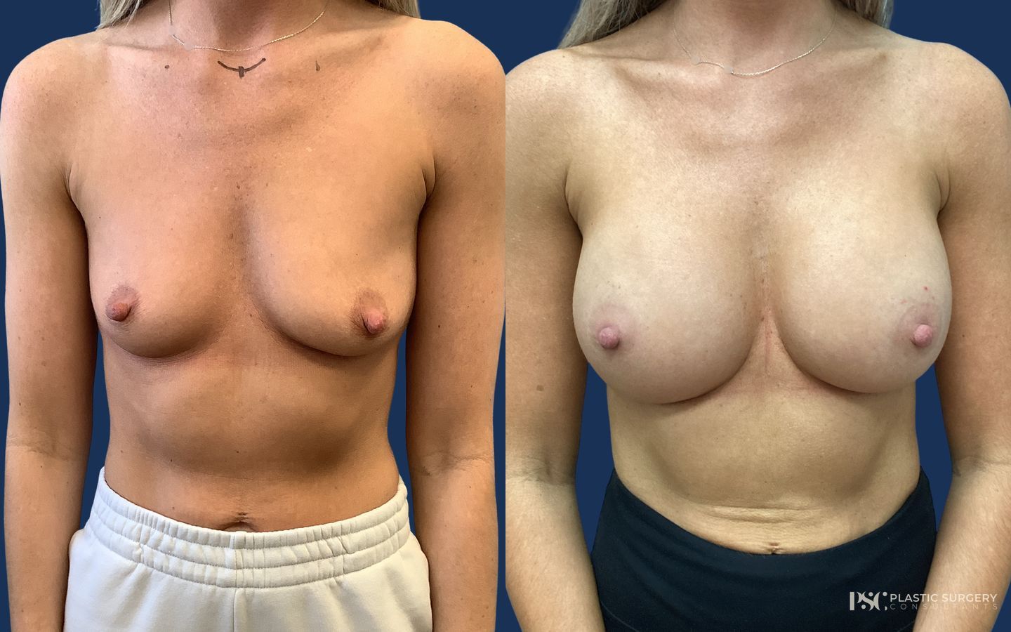 Before and after Breast Augmentation case 26245