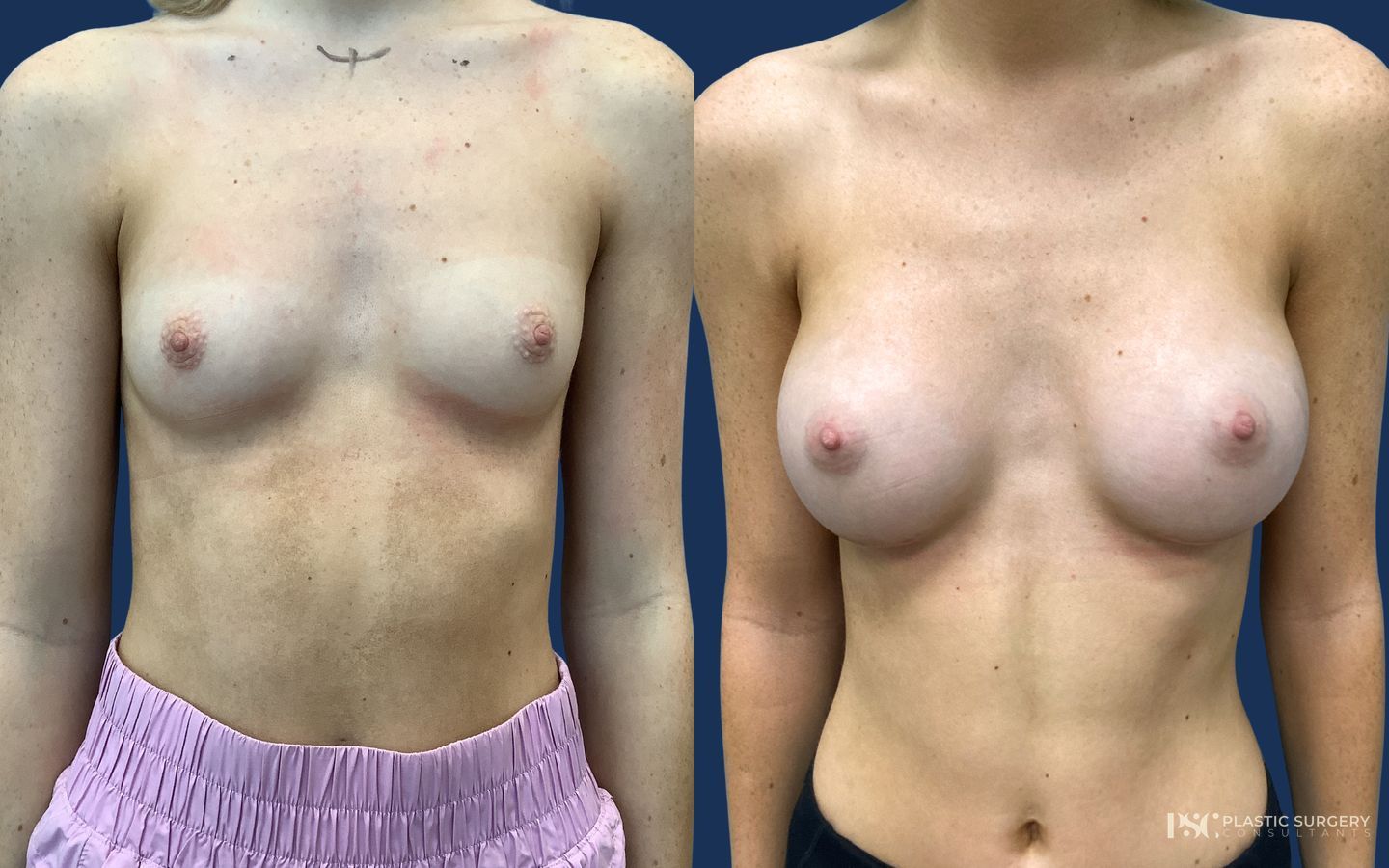 Before and after Breast Augmentation case 23870