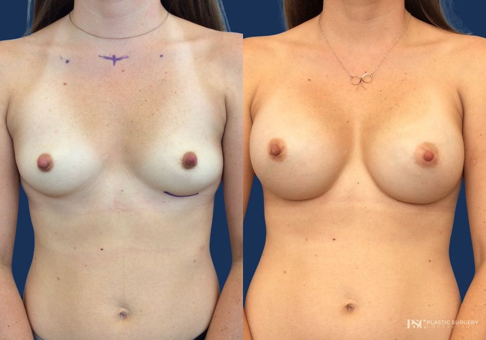 Before and after Dr. Richard J. Wassermann case 23873