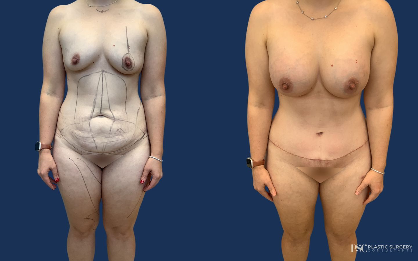 Before and after Breast Augmentation case 26915