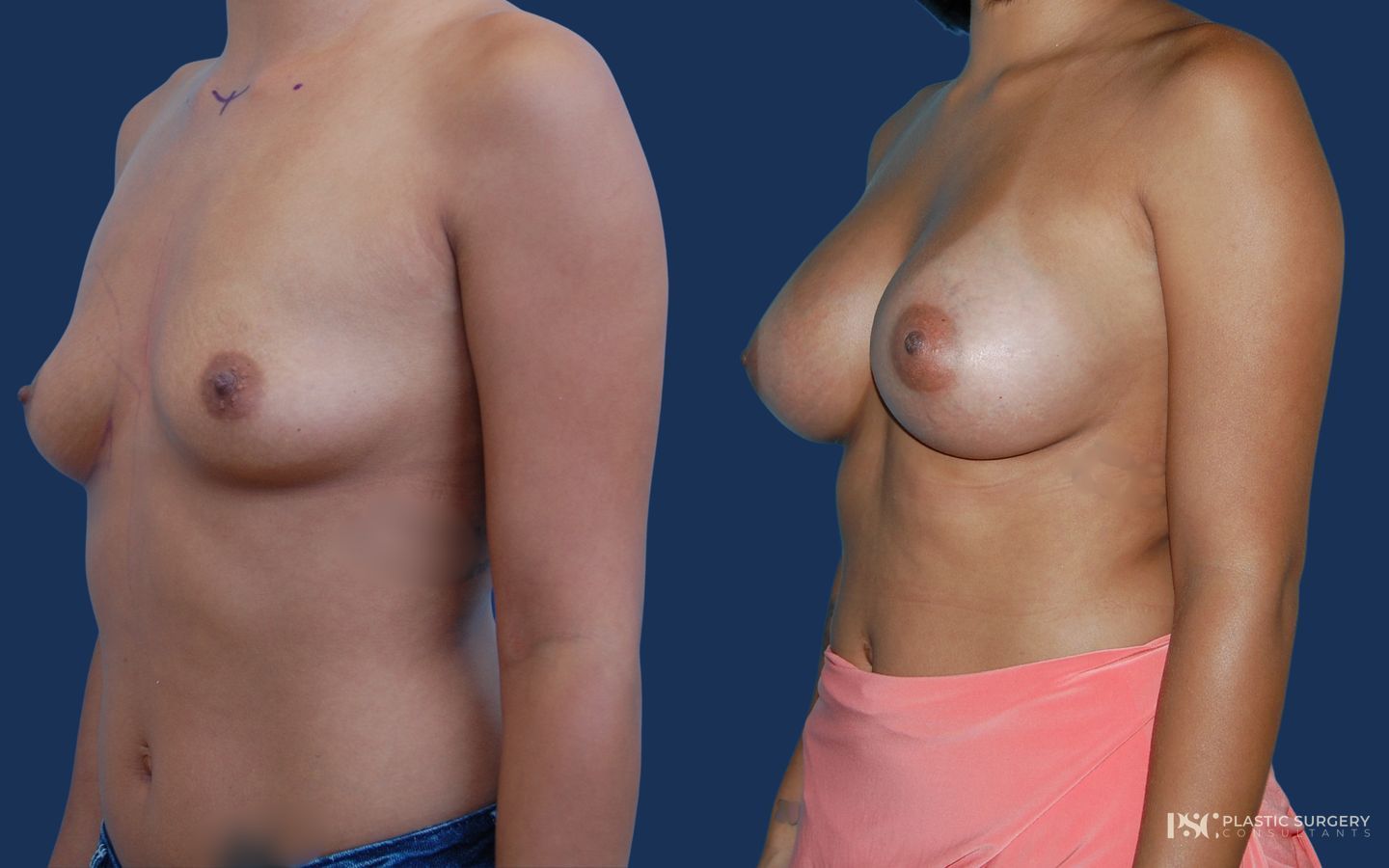 Before and after Breast Augmentation case 23869 - Angle 2